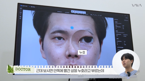 눈&middot;구축코 재수술 후기｜남자 눈코 재수술, 압구정 바바에서 달라진 이유 관련 이미지 7