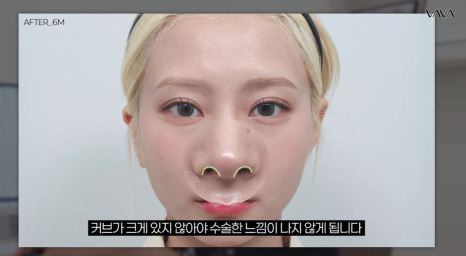 2026년 코성형 트렌드 예측콧대에서 코끝, 그리고 콧구멍까지 보는 시대 관련 이미지 13
