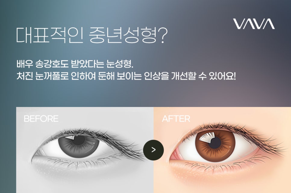 안검하수 회복기간 개인차가 있지만 관련 이미지 4