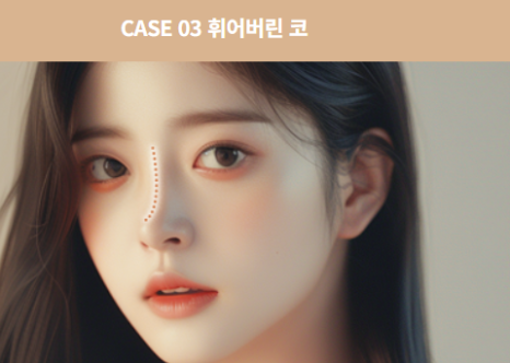 코 재수술, 첫 수술보다 더 신중해야 하는 이유 관련 이미지 8