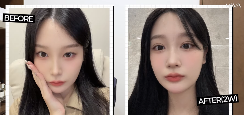 쌍꺼풀 수술 짧은 회복기 가능? 종류별 차이 완전 정리 관련 이미지 16