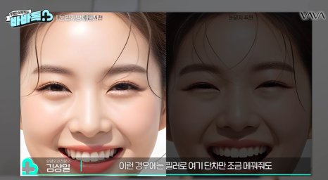 눈밑지방재배치 vs 하안검 vs 필러, 나는 어떤 케이스일까? | 압구정 바바성형외과에서 알려드립니다 관련 이미지 17