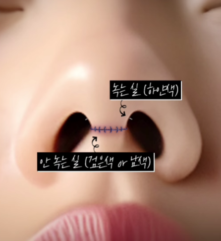 코 성형 후 붓기 기간과 붓기 관리방법 관련 이미지 5