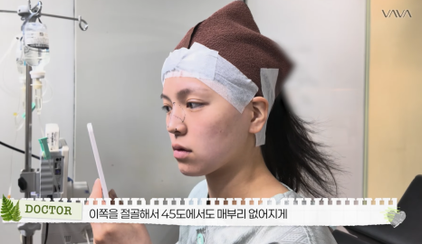 보형물 없이 선명하게｜바바성형외과 무보형물 매부리코 교정 리얼 후기 관련 이미지 6