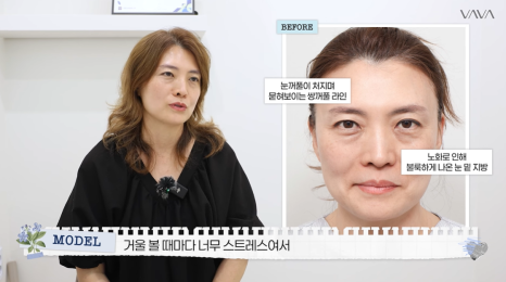 50대에도 자신감 가득 엄마의 두번째 리즈시절, 중년 눈성형&middot;하안검&middot;이마거상 리얼 후기 관련 이미지 4