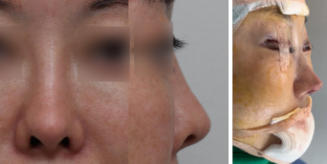 입체적이고 균형 잡힌 코 라인을 위한 자가연골 코 성형(비중격, 귀연골, 늑연골) 관련 이미지 13
