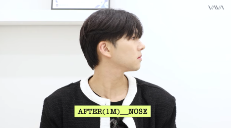 눈&middot;구축코 재수술 후기｜남자 눈코 재수술, 압구정 바바에서 달라진 이유 관련 이미지 4