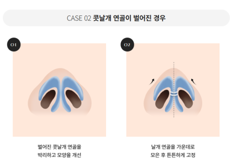 압구정 바바성형외과 자가늑 코성형 후기｜복코&middot;매부리코 교정 한달차 변화 관련 이미지 12