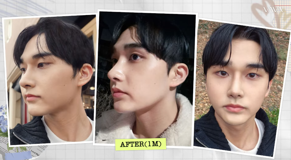 남자 코성형 리얼 후기 한 달 차 사례 비교해 보며 분석하기 관련 이미지 1