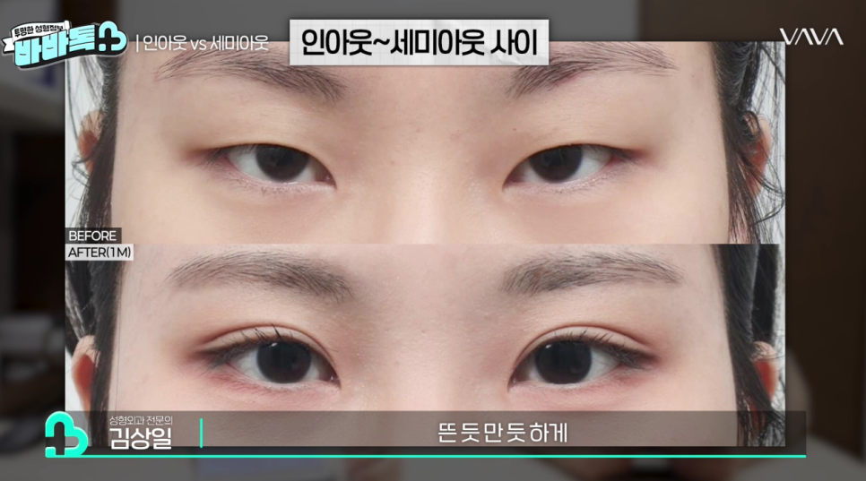 세미아웃라인 인아웃라인 쌍꺼풀 잘 받는 타입 (몽고주름) 관련 이미지 14