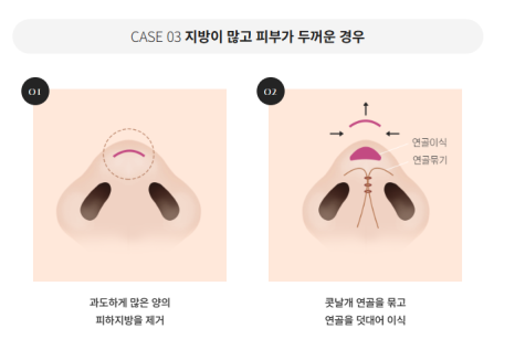 압구정 바바성형외과 자가늑 코성형 후기｜복코&middot;매부리코 교정 한달차 변화 관련 이미지 13