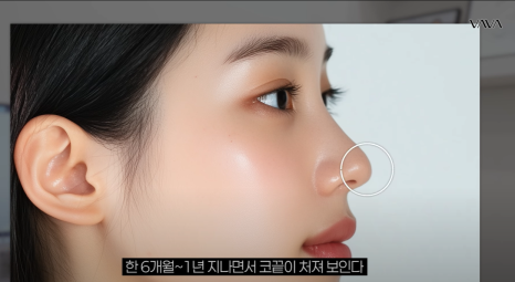 요즘 코성형 트렌드 & 코끝 재수술 알아보기 관련 이미지 7