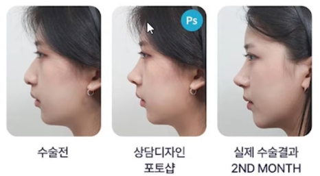 압구정 바바성형외과 코성형 &ndash; 정면&middot;측면 모두 고려한 코라인 설계 관련 이미지 19