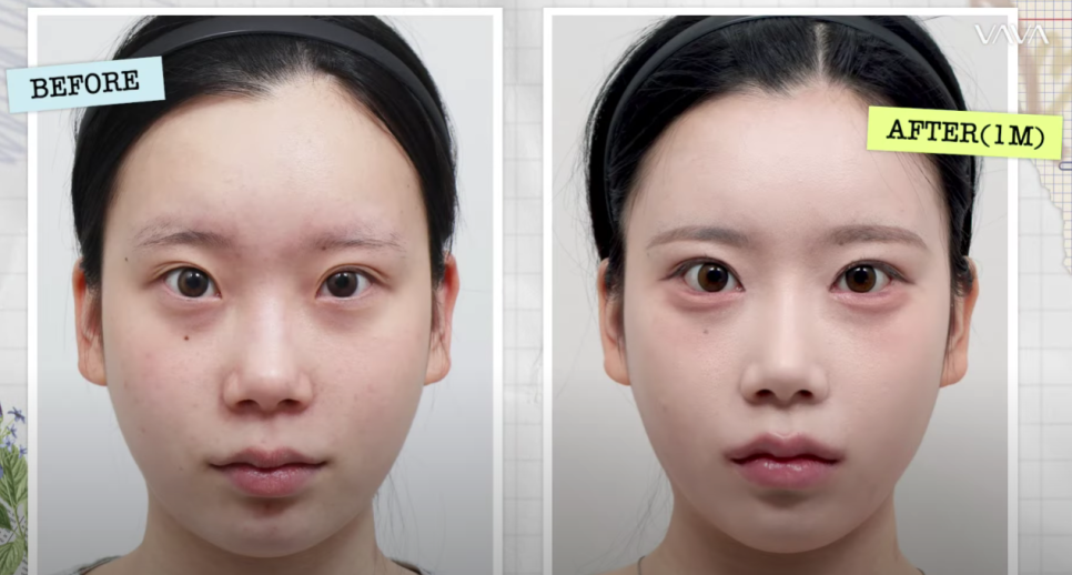 바바성형외과 눈&middot;코 성형 한 달 차 리얼 케이스 (윈터, 카리나 코) 관련 이미지 15