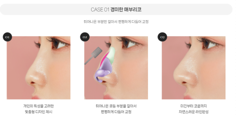 복코, 매부리코, 낮은코 | 바바성형외과 유형별 코성형, 내 코에 맞는 방향 찾기 관련 이미지 10