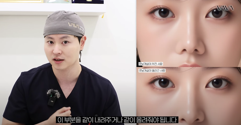 예쁜 코의 공통점은? 성형외과 원장이 알려주는 코 성형 성공하는 방법(리얼 후기 케이스) 관련 이미지 13