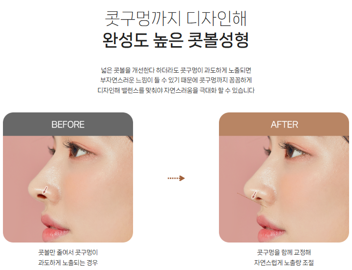 Concerned About Wide Nostrils? | When Alar Reduction Is Needed at BABA Plastic Surgery image 6