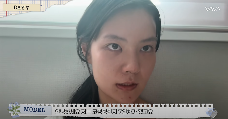 바바성형외과 복코&middot;매부리코&middot;휜코 동시 교정! 직반라인 코성형 리얼 후기 관련 이미지 12