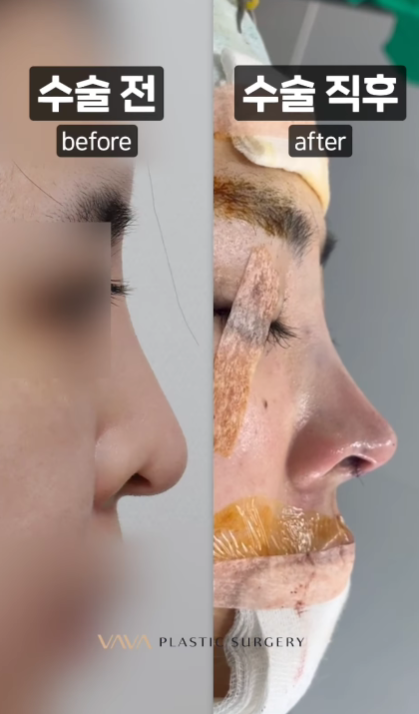 코 성형 후 붓기 기간과 붓기 관리방법 관련 이미지 8