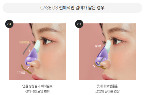 복코, 매부리코, 낮은코 | 바바성형외과 유형별 코성형, 내 코에 맞는 방향 찾기 관련 이미지 22
