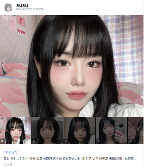 압구정 눈성형, 자연스럽게 달라지는 첫인상 관련 이미지 12