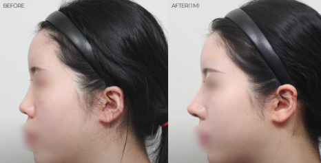 예쁜 코의 공통점은? 성형외과 원장이 알려주는 코 성형 성공하는 방법(리얼 후기 케이스) 관련 이미지 21