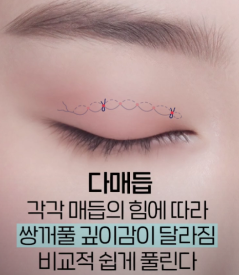 나에게 맞는 쌍꺼풀 수술법 총정리 : 절개, 부분절개, 매몰법까지 관련 이미지 4