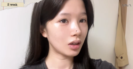 압구정 바바성형외과 자가늑 코성형 후기｜복코&middot;매부리코 교정 한달차 변화 관련 이미지 17