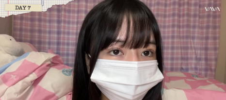 졸려보이는 눈 자연유착 밑트임 위트임으로 또렷하게 (리얼 후기) 관련 이미지 11