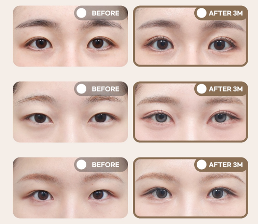 겨울방학 쌍꺼풀 수술, 이것만은 꼭 알아두세요｜쌍꺼풀 수술 가이드 관련 이미지 15