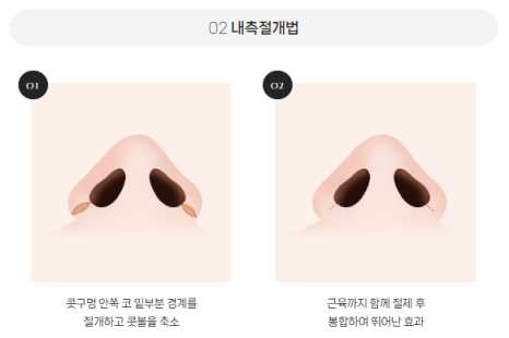 Concerned About Wide Nostrils? | When Alar Reduction Is Needed at BABA Plastic Surgery image 8