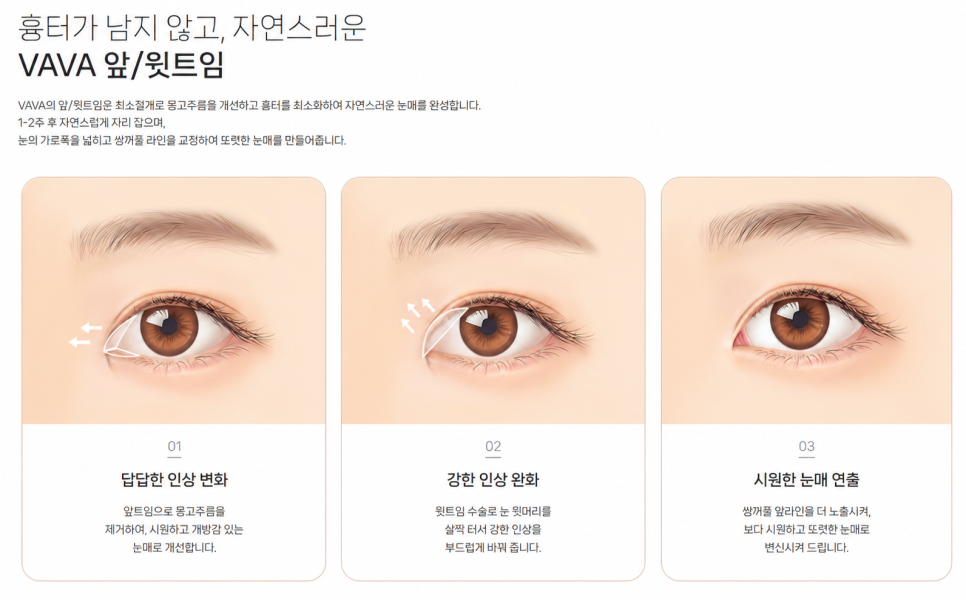 If You’re Concerned About a Tight-Looking Eye Shape | When Medial Epicanthoplasty & Upper Epicanthoplasty Are Needed and How They Differ at 바바성형외과 image 7