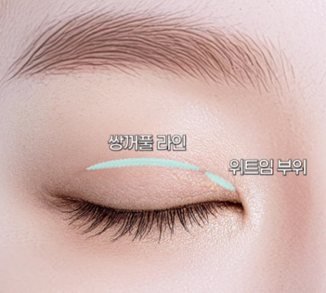 쌍수만으로 충분할까? 윗트임 병행이 필요한 경우 관련 이미지 16