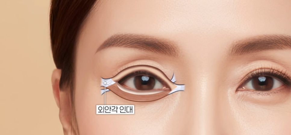 뒤밑트임 수술, 잘 되는 눈 따로 있습니다｜추천 대상&middot;부작용&middot;재유착 정리 관련 이미지 7