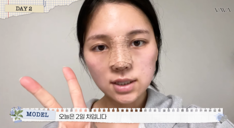 보형물 없이 선명하게｜바바성형외과 무보형물 매부리코 교정 리얼 후기 관련 이미지 10