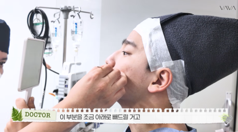 무보형물 직선라인 코성형으로 주먹코&middot;복코 개선｜압구정 바바성형외과 사례 관련 이미지 19