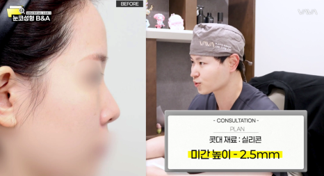 복코 매부리코 긴코 교정 ㅣ 코성형 전후 케이스 (NJZ민지 코) 관련 이미지 4