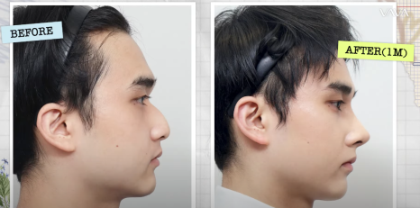 남자 코성형 리얼 후기 한 달 차 사례 비교해 보며 분석하기 관련 이미지 7