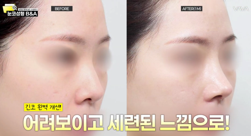 복코 매부리코 긴코 교정 ㅣ 코성형 전후 케이스 (NJZ민지 코) 관련 이미지 1