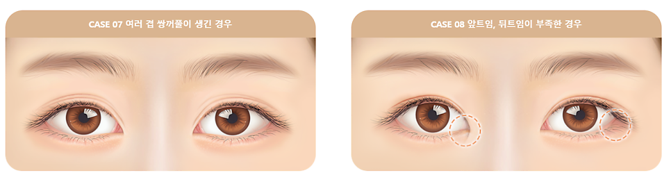 눈 재수술로 보다 완벽한 눈매라인 되찾기 관련 이미지 5