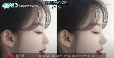 코 수술 성공을 위한 유형과 조건 확인 해보기 관련 이미지 12