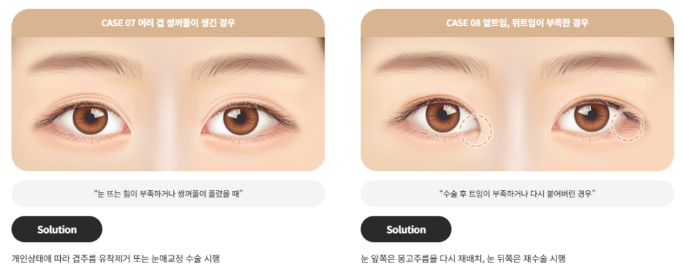 Revision Double Eyelid Surgery May Not Be Just a Line Issue | When Revision Eyelid Surgery Is Needed at Baba Plastic Surgery image 5