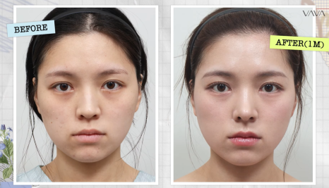 보형물 없이 선명하게｜바바성형외과 무보형물 매부리코 교정 리얼 후기 관련 이미지 23