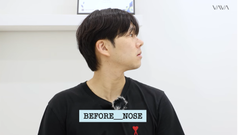 눈&middot;구축코 재수술 후기｜남자 눈코 재수술, 압구정 바바에서 달라진 이유 관련 이미지 3