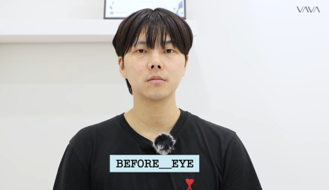 눈&middot;구축코 재수술 후기｜남자 눈코 재수술, 압구정 바바에서 달라진 이유 관련 이미지 1