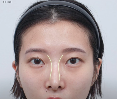 코재수술 원인, 과연 코끝처짐만이 문제일까? 가장 이상적인 라인 알려드립니다 관련 이미지 20