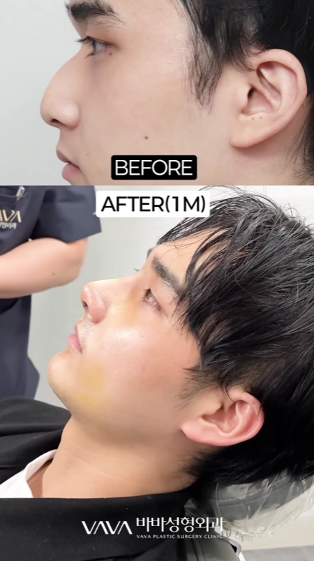 남자 코성형 리얼 후기 한 달 차 사례 비교해 보며 분석하기 관련 이미지 16