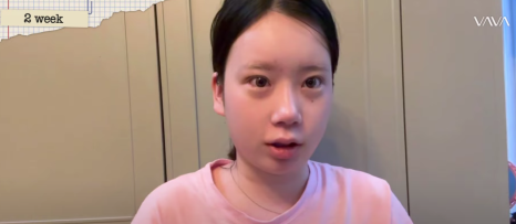 바바성형외과 눈&middot;코 성형 한 달 차 리얼 케이스 (윈터, 카리나 코) 관련 이미지 13