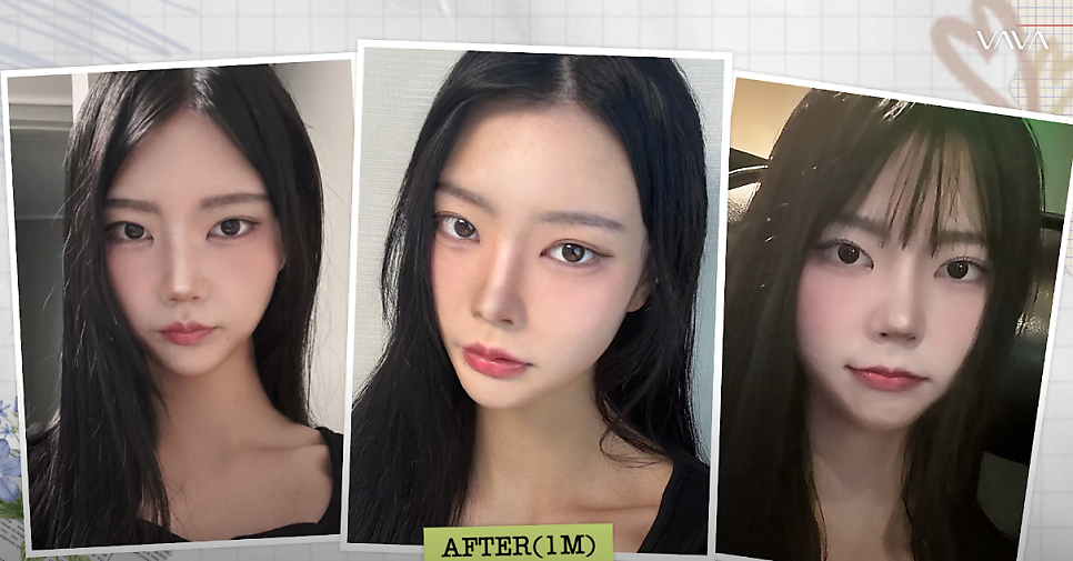 바바성형외과 복코&middot;매부리코&middot;휜코 동시 교정! 직반라인 코성형 리얼 후기 관련 이미지 18