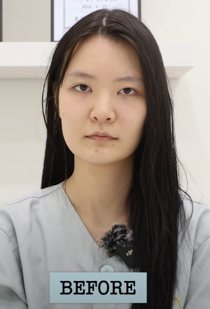 바바성형외과 복코&middot;매부리코&middot;휜코 동시 교정! 직반라인 코성형 리얼 후기 관련 이미지 1